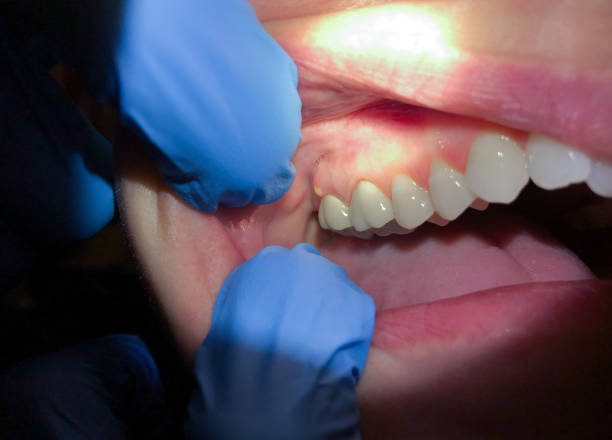 Best Emergency Dental Care for Sports Injuries in Cutlerville, MI